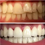 Before and after smile transformation 1