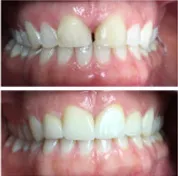 Before and after smile transformation 2