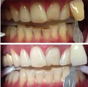Before and after smile transformation 3