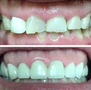 Before and after smile transformation 4