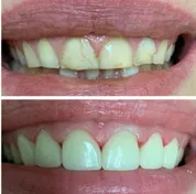 Before and after smile transformation 5