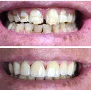 Before and after smile transformation 6